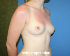 plastic-surgery-breast-augmentation